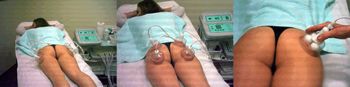 Anticelulitni tretma